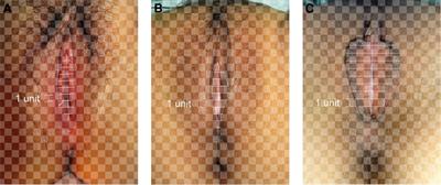 Quantitative analysis of the labia minora morphology in 400 Chinese women: A new method for assessing the shape of the labia minora